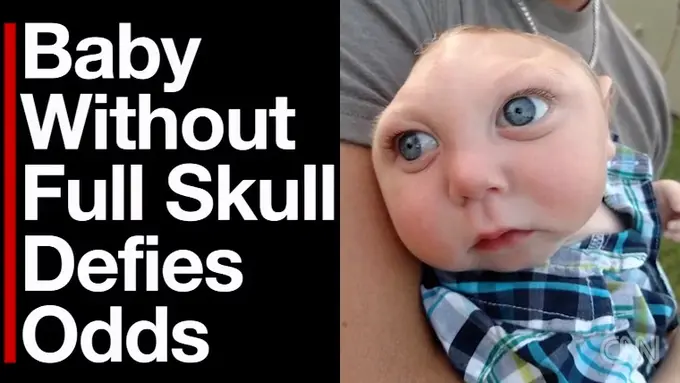 Bayi Ini Terlahir dengan Tempurung Kepala yang Tidak Sempurna