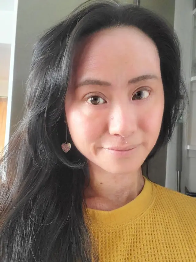 Kisah Perjuangan Wanita Atasi Eksim Hingga Membuat Wajahnya Berubah Ini Bikin Pilu