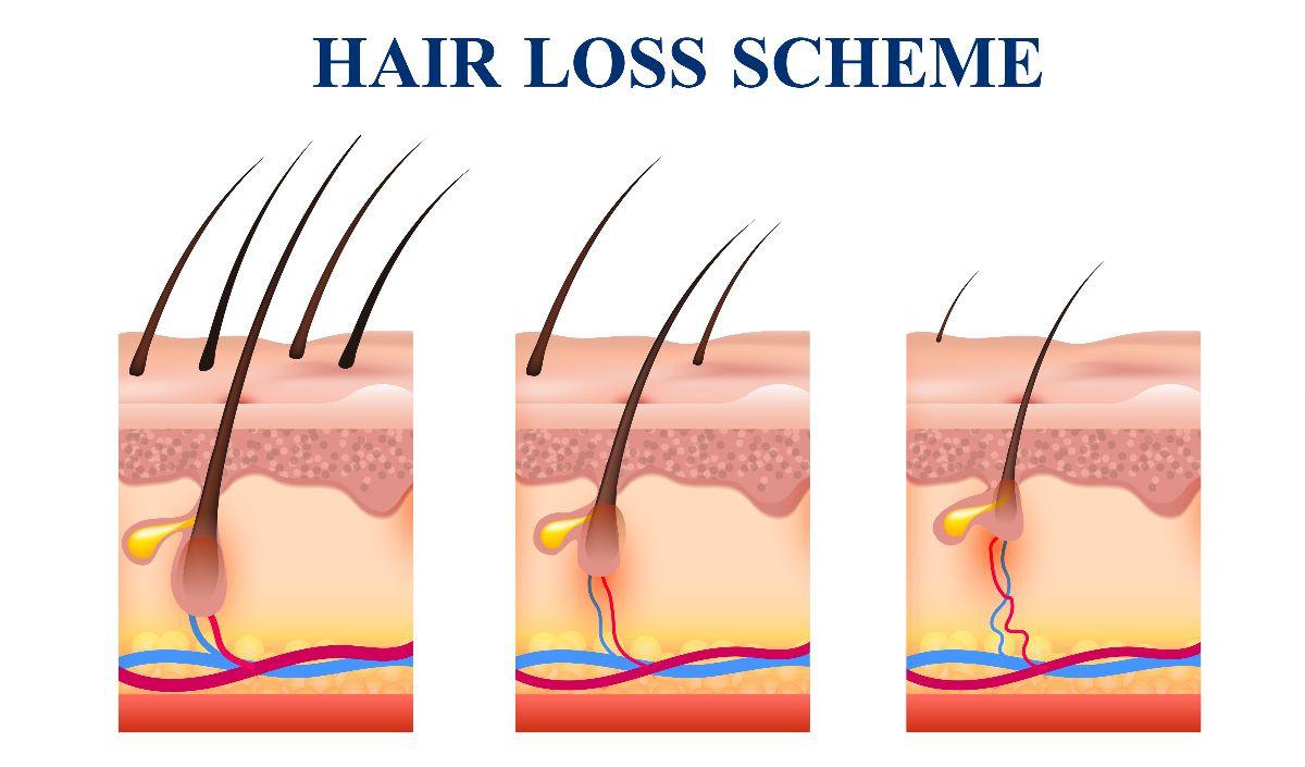 1. Rambut Rontok Tidak Segera Ditangani<br>