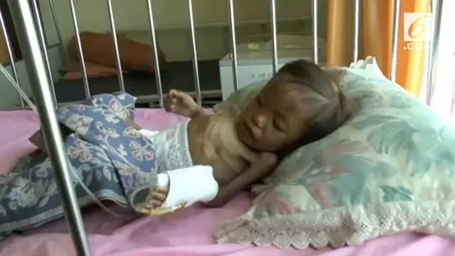 VIDEO: Menyedihkan, Balita Gizi Buruk Tinggal Tulang dan Kulit