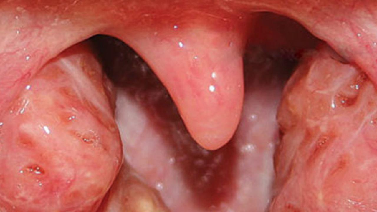 Sisa evolusi (4) amandel