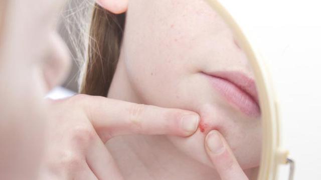 8 Cara Menghilangkan Jerawat yang Gratis