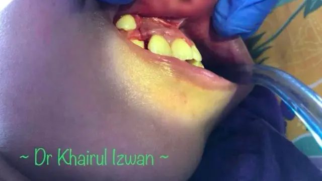 Mengeluh Sakit di Bibir, Ternyata Puluhan Belatung Bersarang di Dalamnya