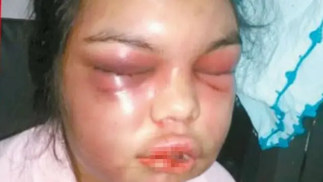 Gara-Gara Unggahan Facebook di Like, Suami Tega Aniaya Istri