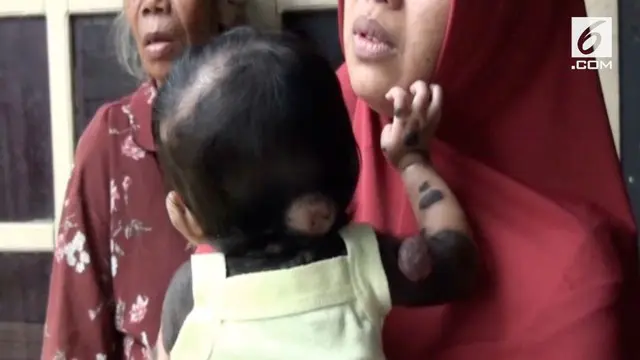 VIDEO: Bayi Ini Terlahir dengan Kulit Menghitam