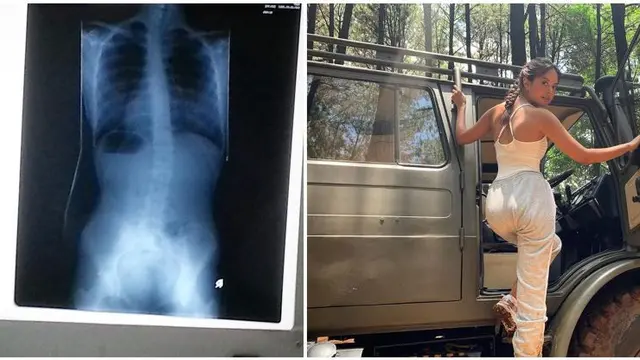 6 Artis Ini Mengidap Skoliosis, Perjuangannya untuk Sembuh Bikin Salut