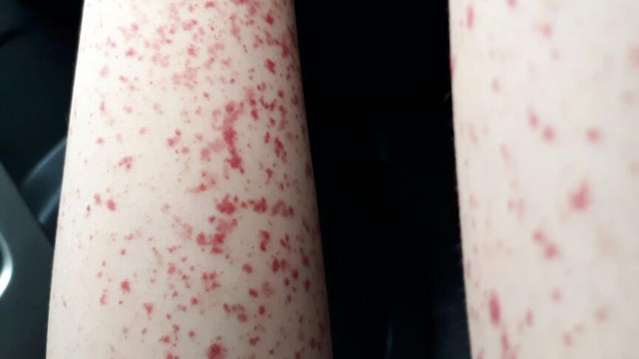 Cara Menghilangkan Bintik-Bintik Kecil di Tangan yang Efektif, Berikut ...