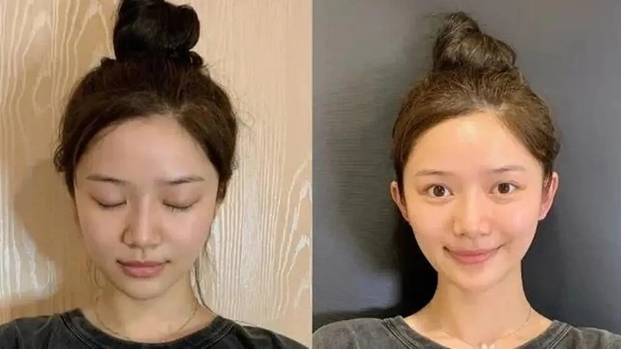 Jadi Tren, Warga China Terobsesi Jalani Operasi Telinga 'Elf' Agar Mirip Peri