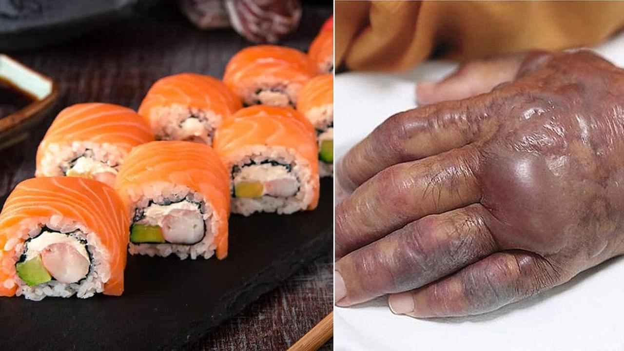 Lengan Pria Ini Diamputasi Usai Makan Sushi