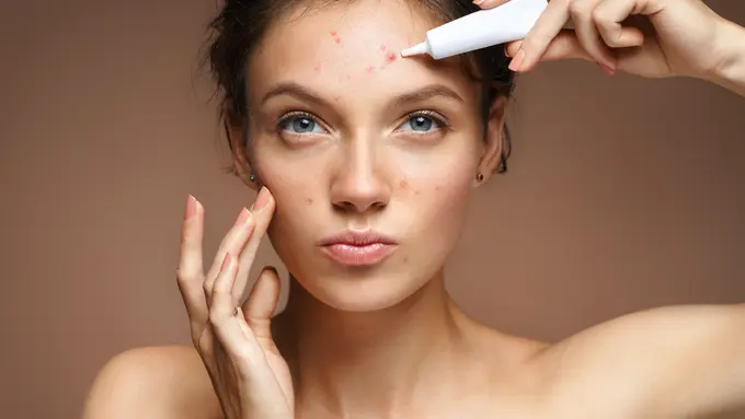 FIMELA Beauty: Acne Prone / Image: Shutterstock