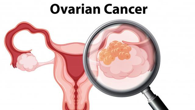 Gambar Ilustrasi Kanker Rahim