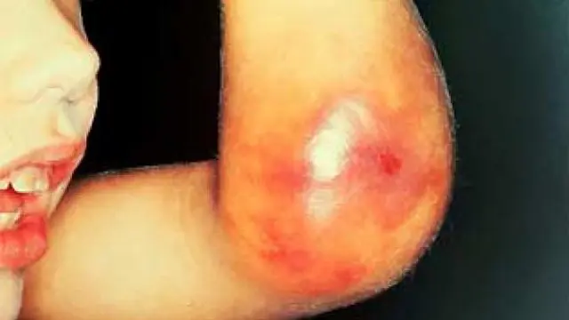 Mengenal Hemofilia, Jenis, Gejala hingga Pengobatannya