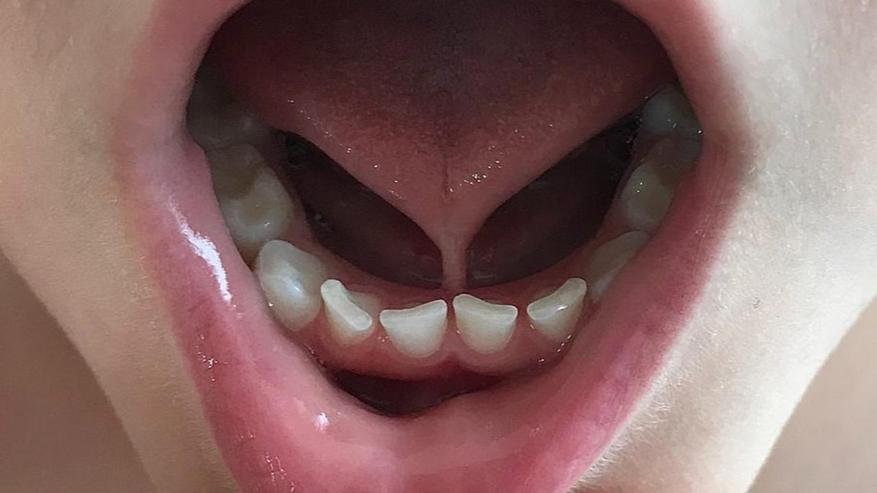 Kenali Apa Itu Tongue Tie dan Ketahui Dampaknya Terhadap Anak
