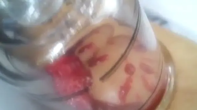 POPS : Mengobati Asam Urat dengan Bekam