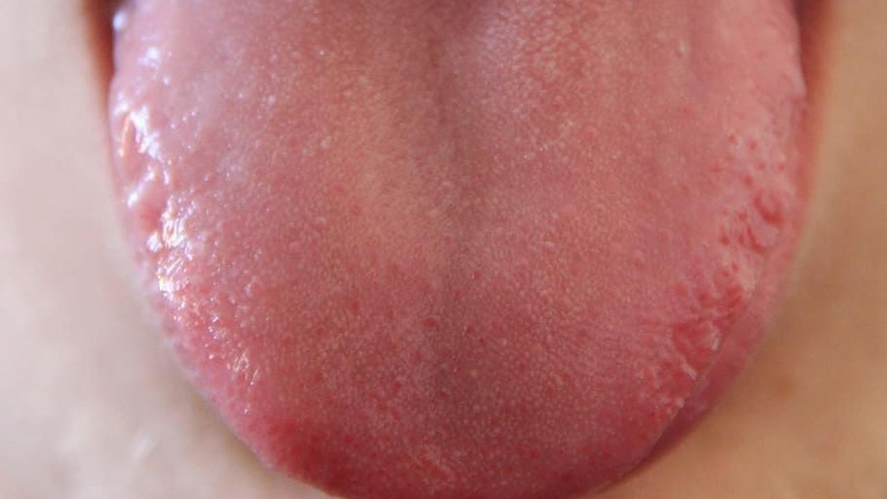 Tanda Diabetes yang Muncul di Mulut, Wajib Diwaspadai