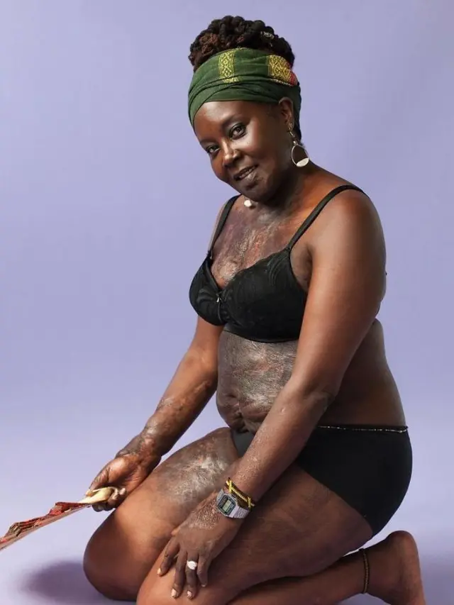 [Bintang] Cerita 5 Wanita dengan Bekas Luka di Tubuhnya, Bikin Terharu