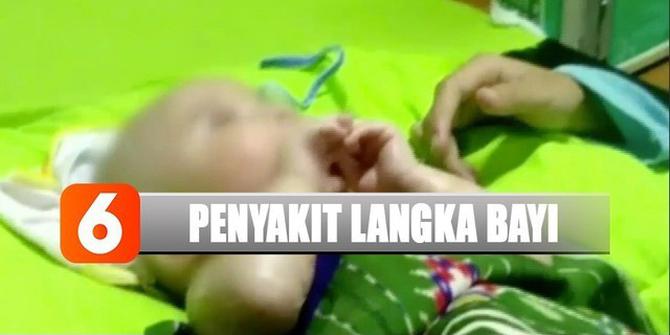 Penyakit Langka, Bayi 6 bulan di Nunukan Memiliki Kulit Keras Seperti Plastik