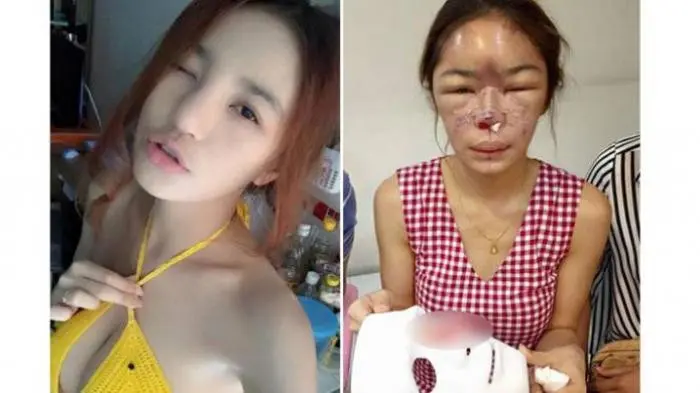 Awalnya Pengin Mancung, Tapi Hasilnya Kok...