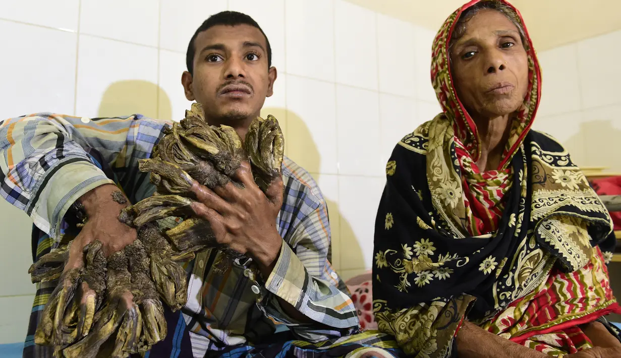 Abul Bajandar (26) mengalami kutil berlebihan yang membuatnya tampak seperti manusia akar, di Dhaka Medical College dan Rumah Sakit, Bangladesh, Minggu (31/1). Bajandar mengaku penyakitnya pertama kali muncul pada 10 tahun lalu. (AFP Photo/Munir uz ZAMAN)