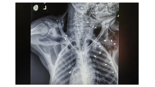 Xray Hope
