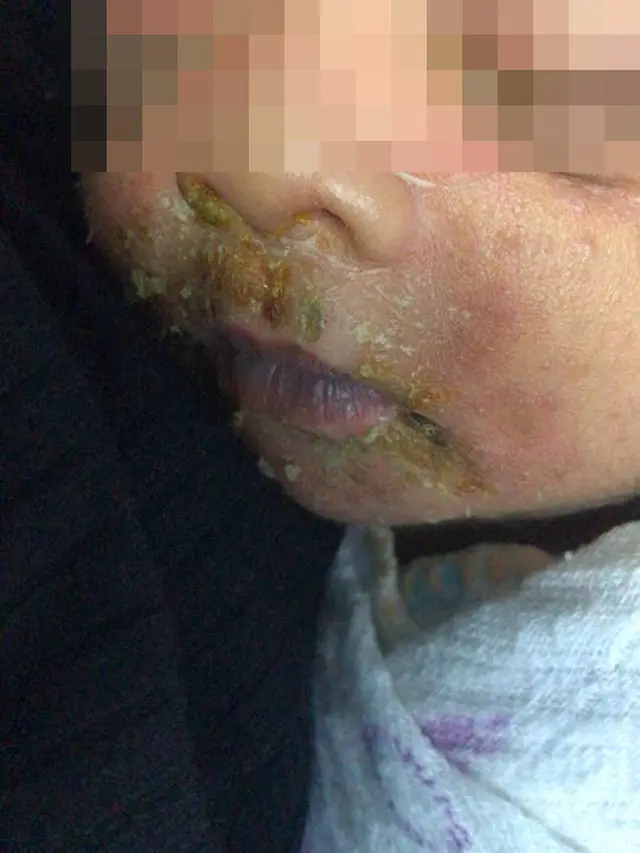 Balita Terinfeksi Penyakit Kulit Setelah Disentuh Kerabat