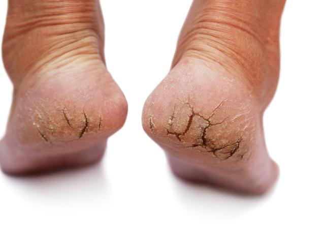 Cara Merawat Kulit Kaki Pecah Pecah Dengan Lidah Buaya Dan Lemon Mudah Banget Hot Liputan6 Com