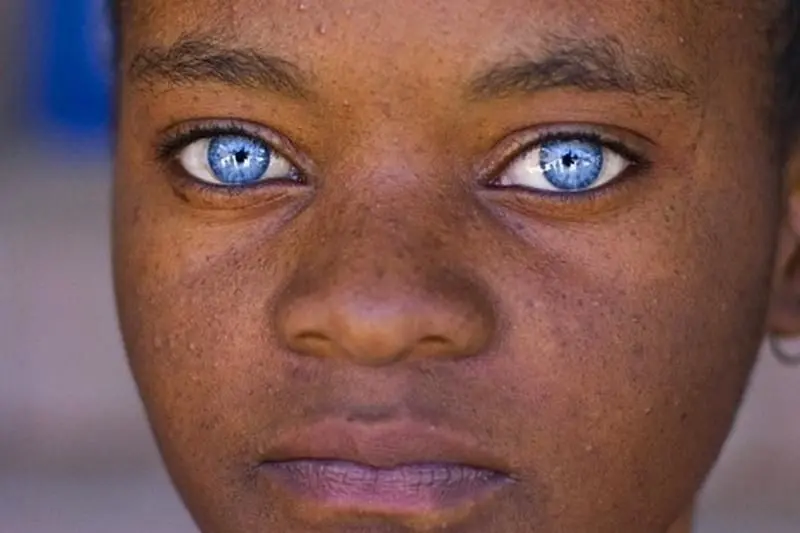 Kondisi langka Ocular Albinism yang dialami oleh seorang gadis kecil di Ghana. Source: ask.naija.ng