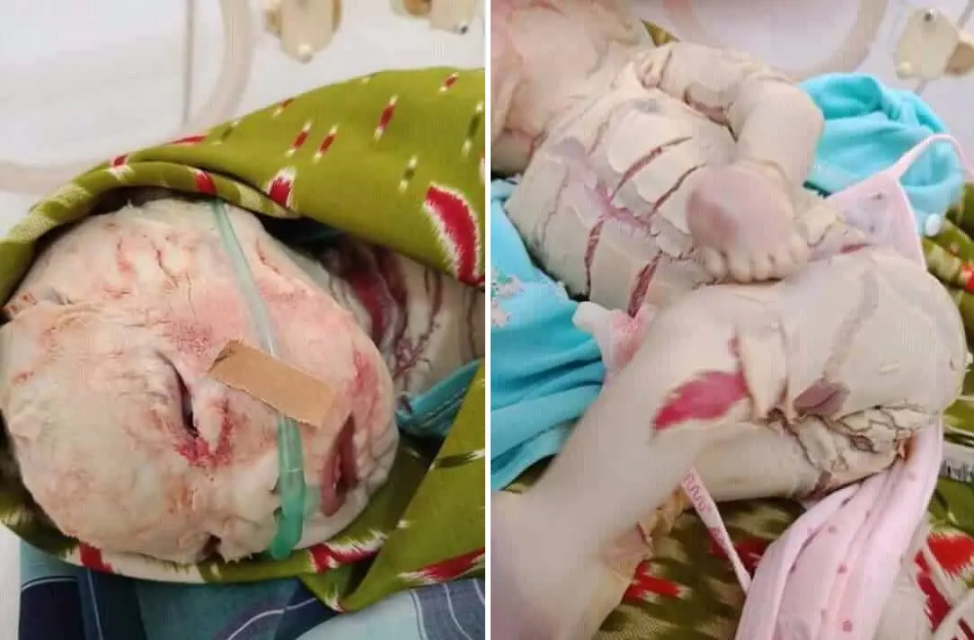 Bayi dengan gejala Harlequin Ichthyosis yang dirawat di RSUD Bahteramas Sulawesi Tenggara, masih dalam penanganan medis. Foto: (Akbar Fua/Liputan6.com)