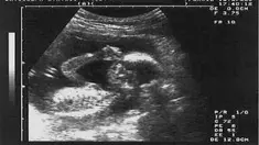 Bagi seorang bayi mengetahui ritme musik sangat sulit untuk dilakukan.Namun untuk janin yang belum lahir satu ini sepertinya memiliki talenta tersebut.Dalam video ini janin yang berusia 14 minggu ini terlihat bertepuk tangan ketika kedua orang tuanya...