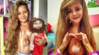 gadis kecil berusia 8 tahun dengan kondisi jantung yang hanya ditutupi oleh kulit tipis, membuktikan prognosis dokter salah (Instagram/dariborun)