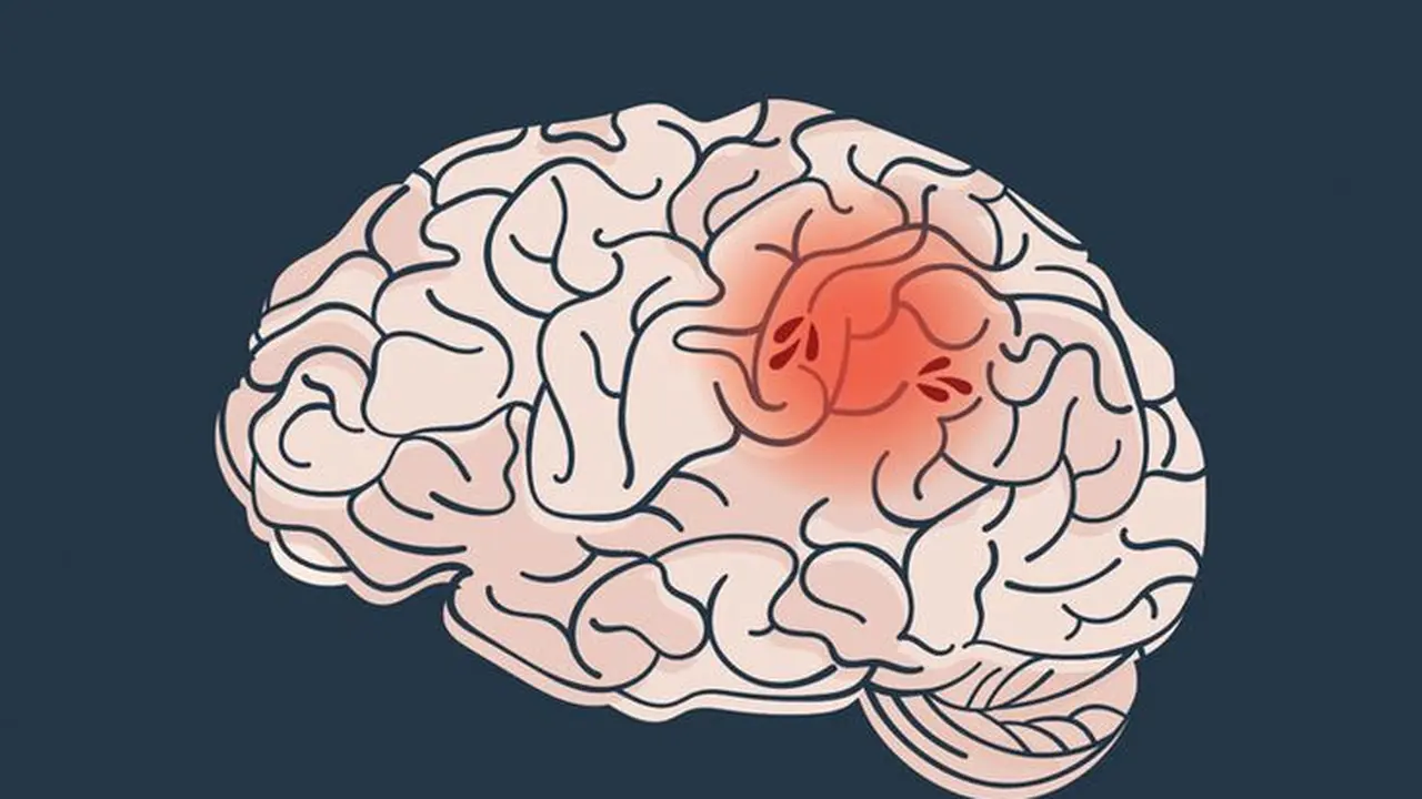 Stroke. (foto: Pinterest).