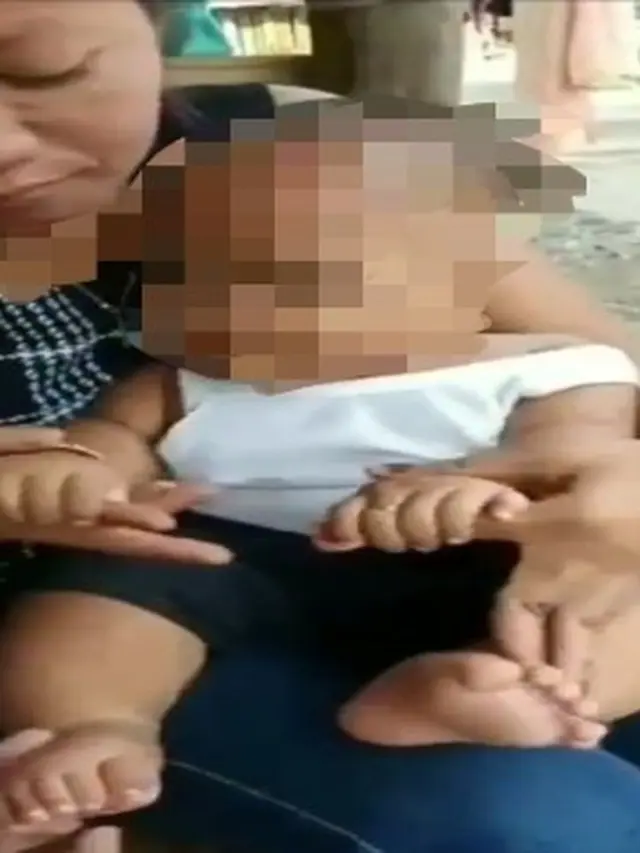 Heboh Balita Kakak Beradik Asal Indramayu Punya 12 Jari di Tangan dan Kaki