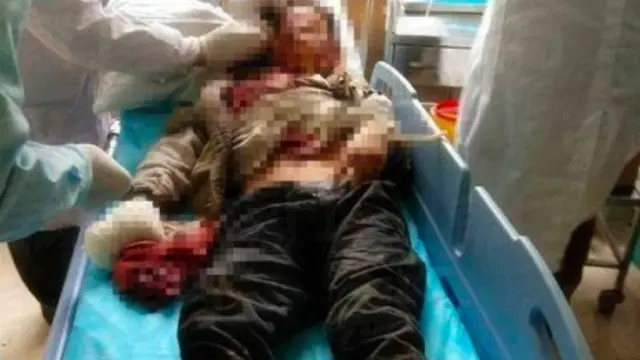 Ponsel Meledak, Bocah di Tiongkok Kehilangan Jari Telunjuk