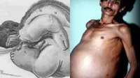 Dikira Tumor, Ternyata Pria Ini Punya Kembaran Parasit di Dalam Perut (Sumber: Documenting Reality, Creative Commons)