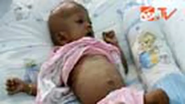 Balita Gizi Buruk Ini Butuh Uluran Tangan
