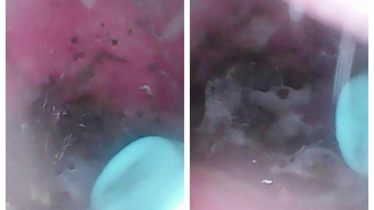 Bikin Merinding, Telinga Wanita Ini Gatal Karena Jadi Sarang Laba-Laba