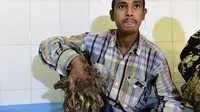 Abul Bajandar (26) menunjukkan tangannya yang ditumbuhi kutil berlebih saat dirawat di Dhaka Medical College dan Rumah Sakit, Bangladesh, Minggu (31/1). Kini kedua tangannya sudah tak bisa berfungsi sebagaimana biasanya. (AFP Photo/Munir uz ZAMAN)
