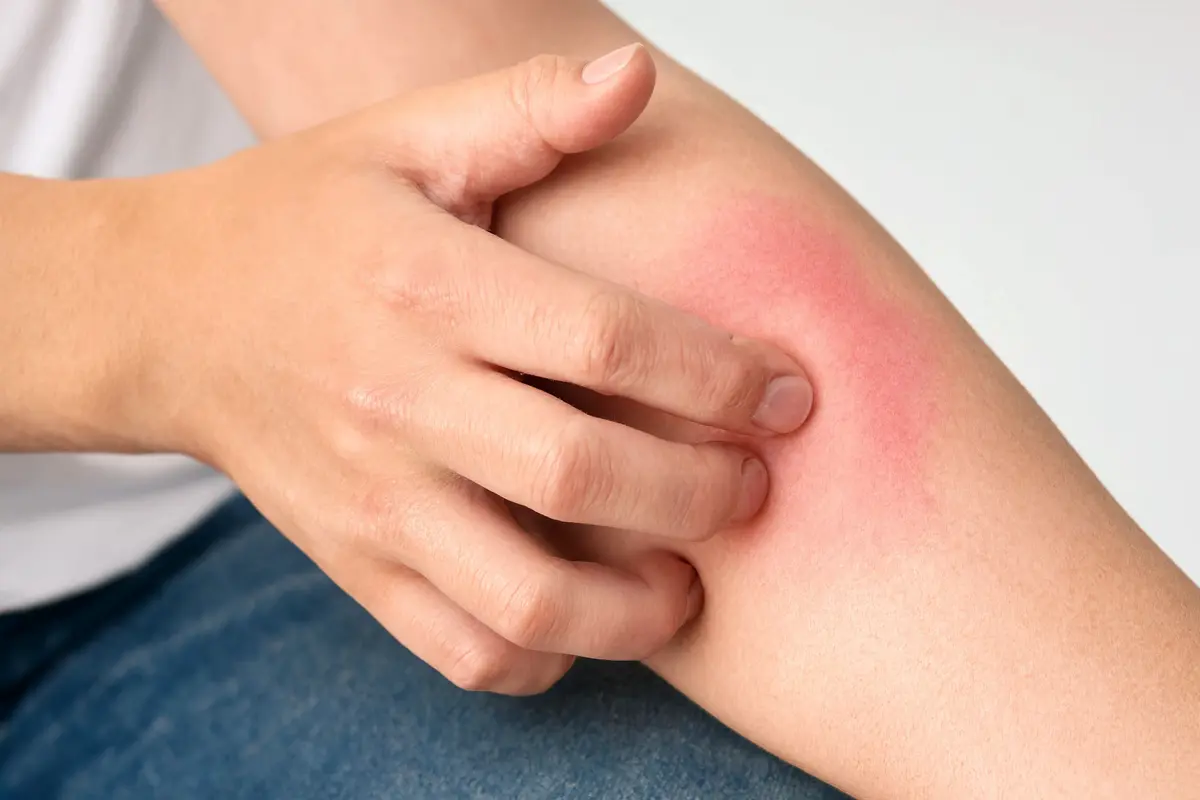 Itchy Skin