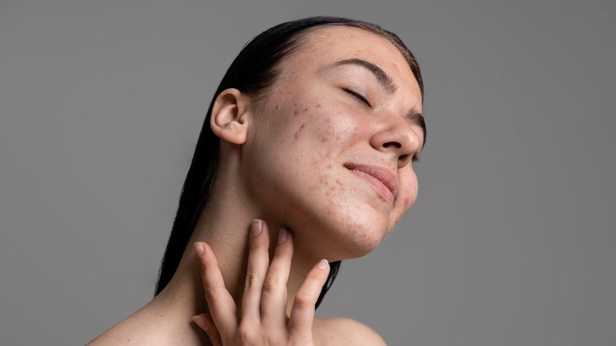 Jerawat Hormon Datang Tak Diundang, Ini 5 Langkah Perawatan yang Bisa Kamu Coba