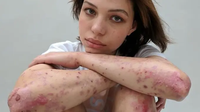 [Bintang] Cerita 5 Wanita dengan Bekas Luka di Tubuhnya, Bikin Terharu