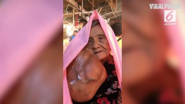 Berita Tumor Di Pipi Hari Ini Kabar Terbaru Terkini Liputan6 Com