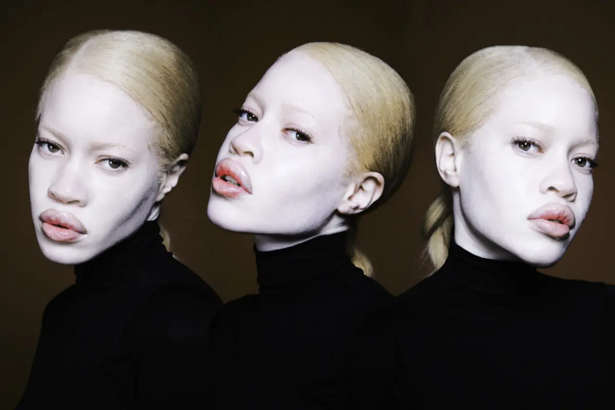 Meski Menderita Albino, 10 Model Ini Sukses Mendunia
