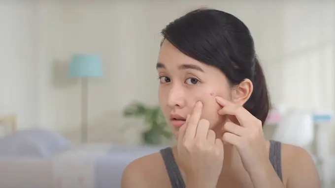 Perang Melawan Jerawat: Panduan Lengkap untuk Kulit Bersih dan Sehat!