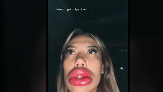 Perempuan Alami Bibir Super Bengkak akibat Alergi Usai Jalani Lip Filler