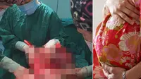 Tumor 15 kg dari perut seorang wanita di China. (Shanghai General Hospital)