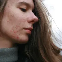 Bekas jerawat tak harus jadi masalah permanen, dengan cara yang efektif dan tepat bekas jerawat dapat memudar (Foto: Barbara Krysztofiak/Unsplash)