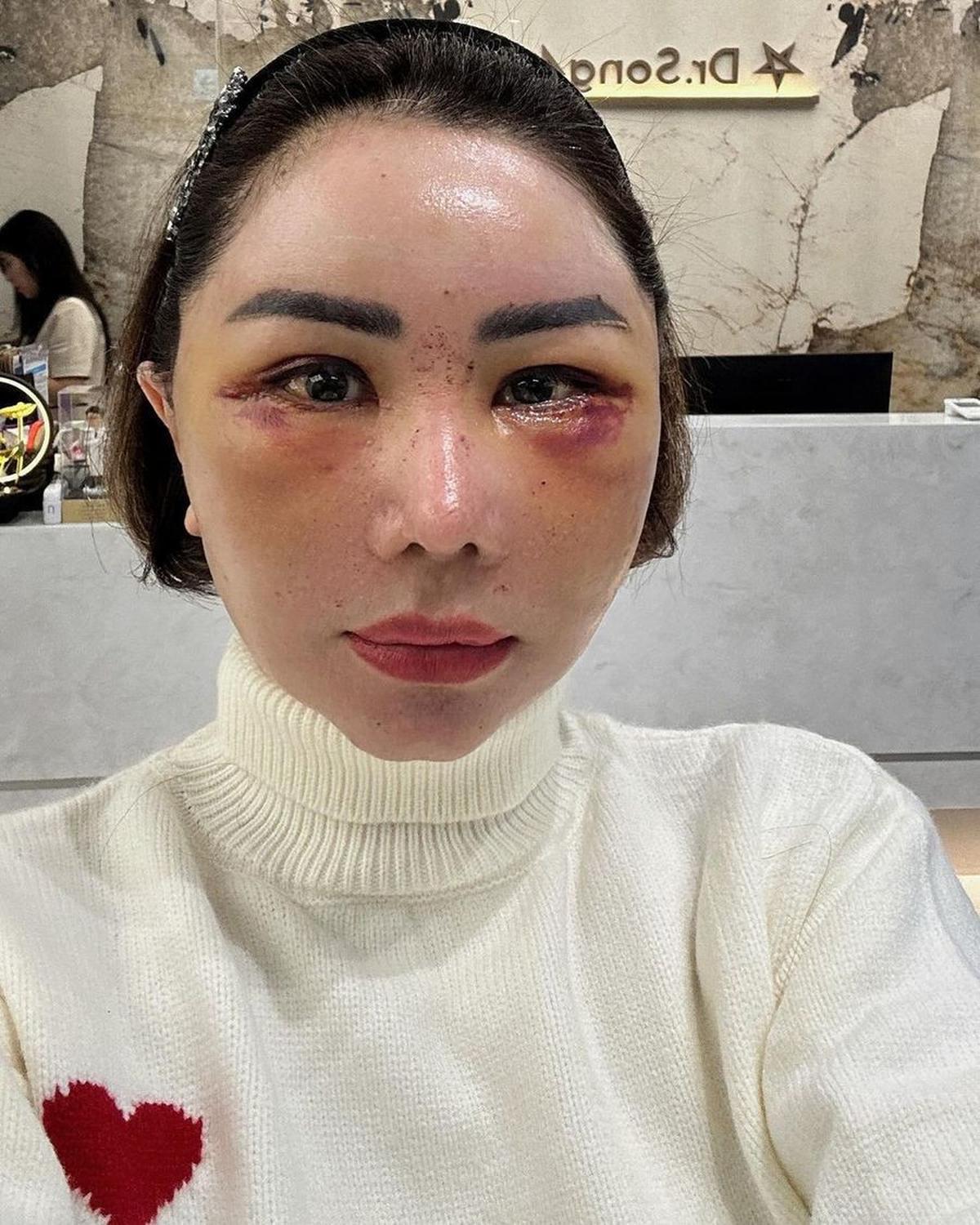 Potret Femmy Permatasari Setelah Oplas di Korea, Rela Wajah Bengkak dan 'Jelek' Dulu Pasca Lakukan 6 Prosedur Operasi