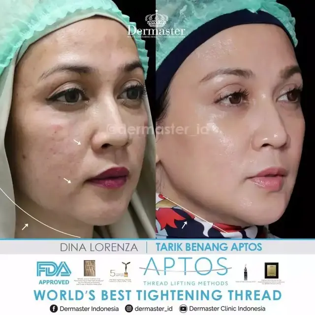 Potret Dina Lorenza sebelum dan sesudah tanam benang (Sumber: Instagram/dermaster_id)