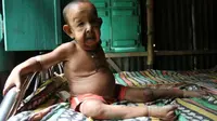 Akibat Penyakit Langka Balita Ini Tampak seperti Orang Tua