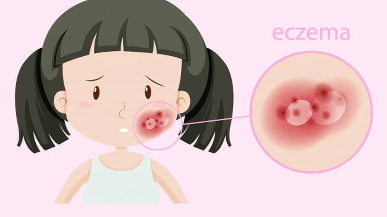 Gambar Ilustrasi Penderita Eksim